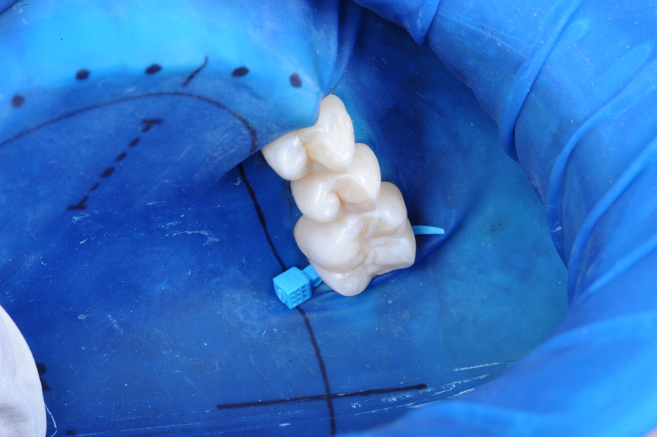 OptraDam | Dental Isolation Products| Ivoclar USA