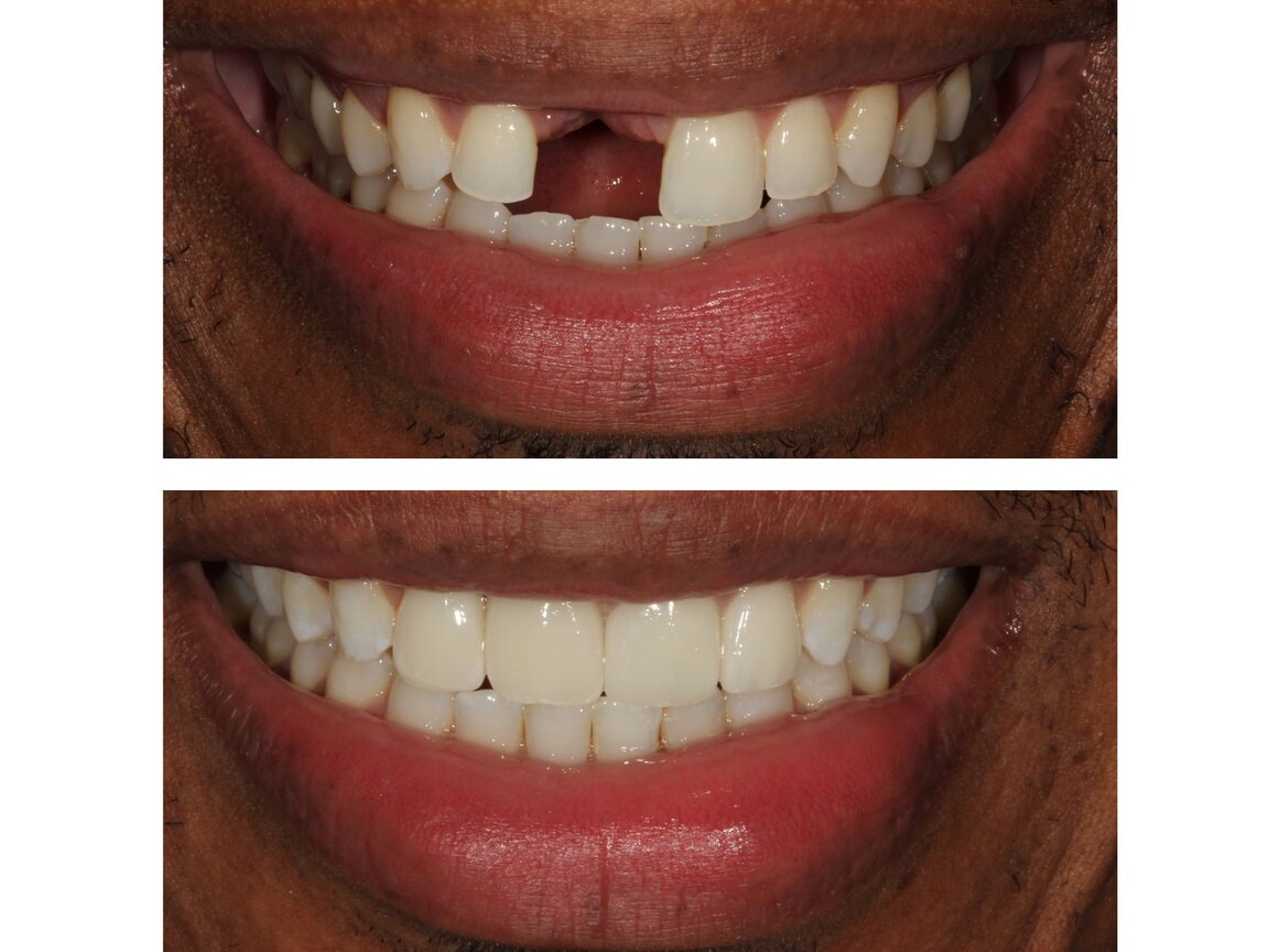 IPS e.max CAD | Lithium disilicate block for CAD/CAM | Ivoclar