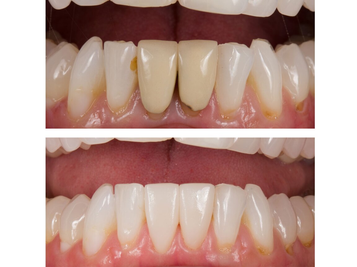 IPS e.max CAD | Lithium disilicate block for CAD/CAM | Ivoclar