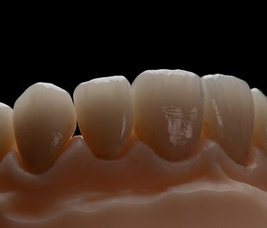 Figure 17: Showing the graduated translucency through the zirconia crowns