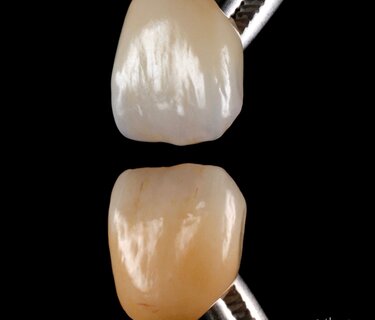 IPS e.max ZirCAD Prime Esthetic restoration by Dani Farago