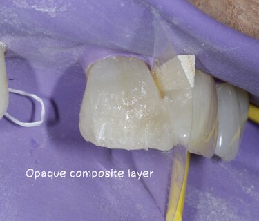 Using Minimally Invasive Dentistry to Guide Treatment Choices