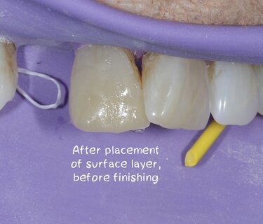 Using Minimally Invasive Dentistry to Guide Treatment Choices