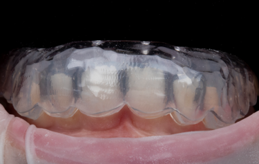 Figure 5: SmileFast stent placement