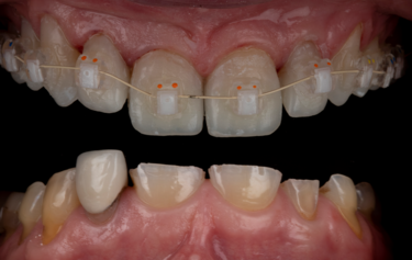 Figure 8: Immediate result after stent-guided composite build-up and orthodontic bracket placement