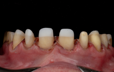 Figure 12: Provisional tooth preparations