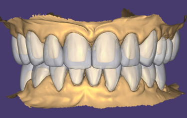 Figure 14: Final full mouth digital restoration designs