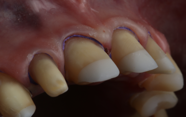 Figure 13: Gingival retraction on final preparations
