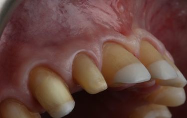 Figure 18: Exceptional tissue health after temporary crown removal