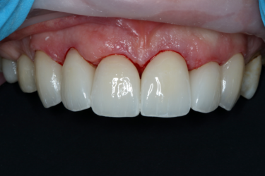 Figure 4-5: This smile makeover involved full coverage crowns for teeth #13-23 milled from IPS e.max CAD in MT B1. The monolithic crowns were stained and glazed to optimize the esthetics.