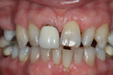Figure 4-5: This smile makeover involved full coverage crowns for teeth #13-23 milled from IPS e.max CAD in MT B1. The monolithic crowns were stained and glazed to optimize the esthetics.