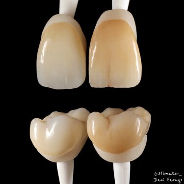 IPS e.max ZirCAD Prime esthetic restoration made by Dani Farago