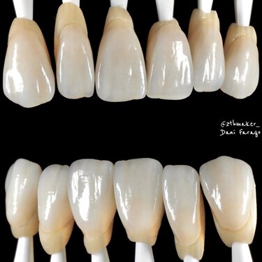 *IPS e.max Press Restoration by Dani Farago