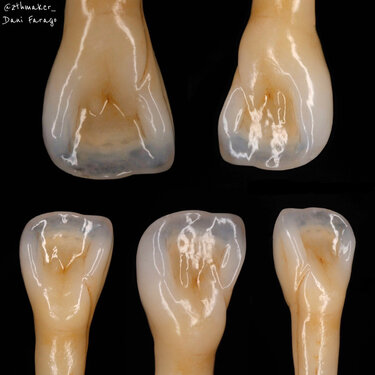 IPS e.max Press restoration by Dani Farago