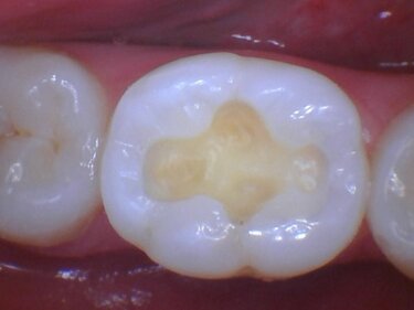 Figure 3: Anesthesia was administered, the carious lesion removed and the tooth prepared for a bulk fill composite.