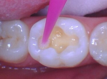 Figure 5: A desensitizer and disinfectant was scrubbed into the cavity of the prepared tooth.