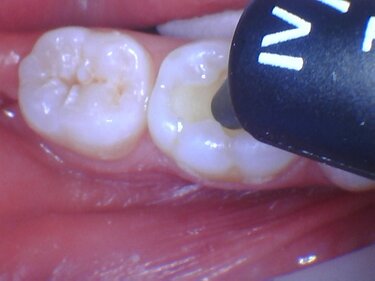 Figure 9: A 4mm single layer of esthetic composite material was applied to the preparation.