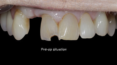 1.	Patient awaiting healing for implant placement for tooth #7, required repair of fractured tooth #8. 