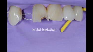 2.	Isolation is key to restorative success when using a direct composite technique. Prior to isolation of the site, shade matching  should be completed while the tooth is hydrated.