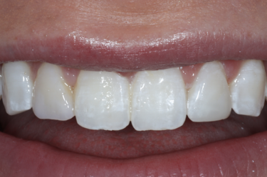 How to Repair Tooth Enamel, Amherst Dentist