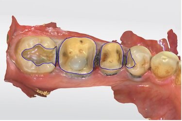 Figure 12: The preparations were scanned and margins delineated using CEREC Primescan. 