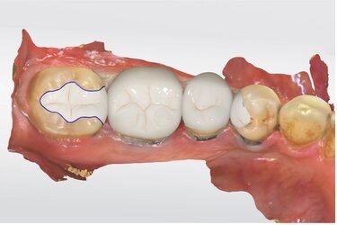 Figure 13: The inlays and full contour crowns designed using CEREC Primescan.