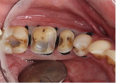 Figure 11: During tooth preparation the amalgam fillings were removed, decay excavated, and compromised tooth structure reduced.