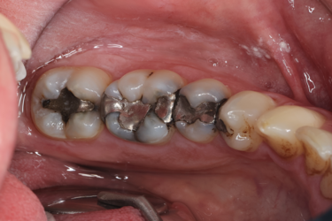 Figure 10: This same-day case involved restoring teeth #1-#3 with full-contour crowns and inlays. The patient was experiencing symptoms similar to cracked tooth syndrome.
