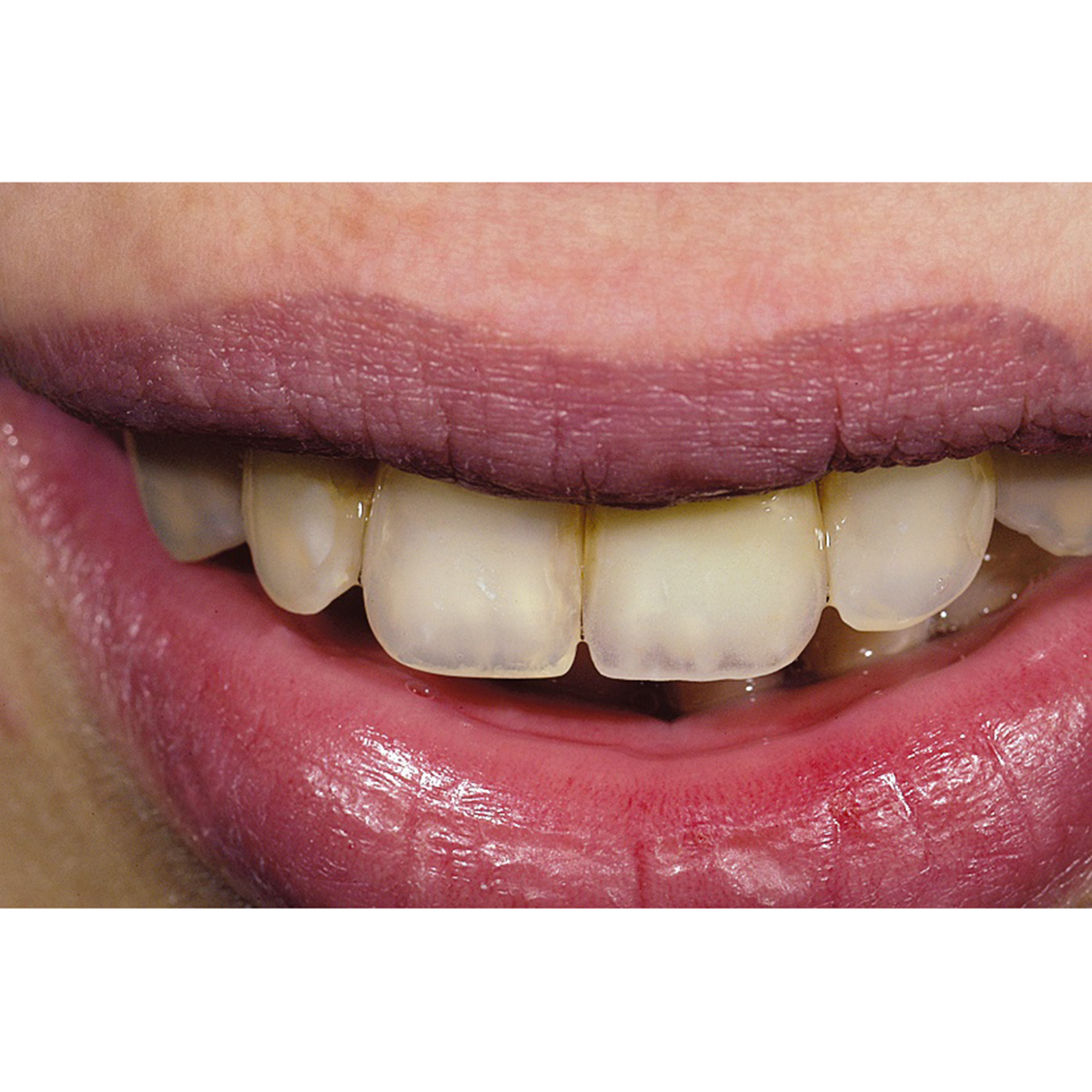 IPS e.max Press Refill MT 5 Stk. | All Ceramics | Ivoclar Vivadent US